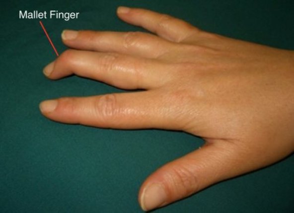 Orthopedics Products |  Mallet Finger Mallet Finger Splint.